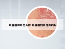 银屑病泻血怎么做 银屑病刺血是真的吗