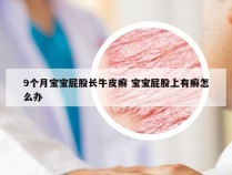 9个月宝宝屁股长牛皮癣 宝宝屁股上有癣怎么办