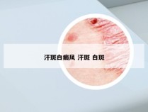 汗斑白癜风 汗斑 白斑