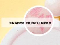 牛皮癣的图片 牛皮皮癣什么症状图片