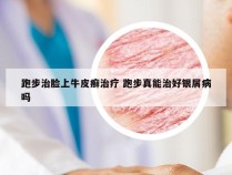 跑步治脸上牛皮癣治疗 跑步真能治好银屑病吗