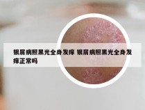 银屑病照黑光全身发痒 银屑病照黑光全身发痒正常吗