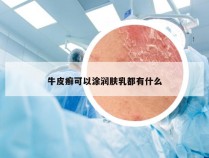 牛皮癣可以涂润肤乳都有什么