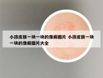 小孩皮肤一块一块的像癣图片 小孩皮肤一块一块的像癣图片大全