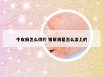 牛皮癣怎么得的 银屑病是怎么染上的