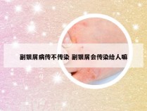 副银屑病传不传染 副银屑会传染给人嘛