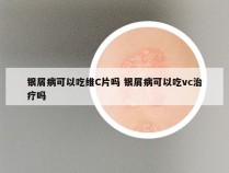 银屑病可以吃维C片吗 银屑病可以吃vc治疗吗