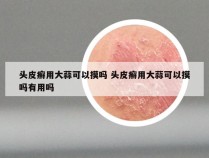 头皮癣用大蒜可以摸吗 头皮癣用大蒜可以摸吗有用吗