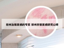 郑州治银屑病的专家 郑州市银屑病研究口碑