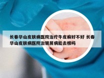 长春华山皮肤病医院治疗牛皮癣好不好 长春华山皮肤病医院治银屑病能去根吗