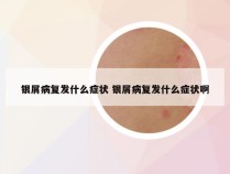 银屑病复发什么症状 银屑病复发什么症状啊