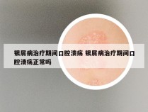 银屑病治疗期间口腔溃疡 银屑病治疗期间口腔溃疡正常吗