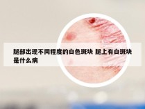 腿部出现不同程度的白色斑块 腿上有白斑块是什么病