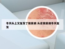 冬天头上又复发了银屑病 头皮银屑病冬天复发