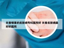 长春哪里的皮肤病专科医院好 长春皮肤病最好的医院