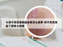 小孩子洗完澡就起皮癣怎么回事 孩子洗完澡起了很多小疙瘩