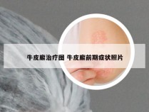 牛皮廨治疗图 牛皮廨前期症状照片