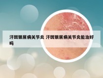 汗斑银屑病关节炎 汗斑银屑病关节炎能治好吗