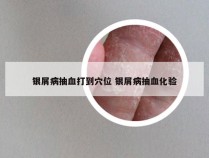 银屑病抽血打到穴位 银屑病抽血化验