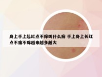 身上手上起红点不痒叫什么癣 手上身上长红点不痛不痒越来越多越大