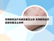 生物制剂治疗皮肤效果怎么样 生物制剂治疗皮肤效果怎么样啊