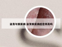 染发与银屑病 染发银屑病痊愈率高吗