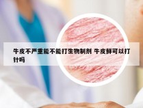 牛皮不严重能不能打生物制剂 牛皮鲜可以打针吗