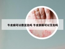 牛皮癣可以敷泥灸吗 牛皮肤癣可以艾灸吗