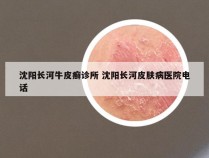 沈阳长河牛皮癣诊所 沈阳长河皮肤病医院电话