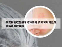 牛皮癣能吃盐酸米诺环素吗 皮炎可以吃盐酸米诺环素胶囊吗