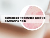 银屑病可能是新冠疫苗的副作用 银屑病可能是新冠疫苗的副作用嘛