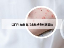 江门牛皮癣 江门皮肤病专科医医院