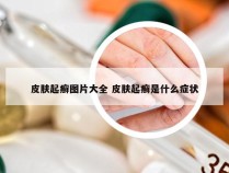 皮肤起癣图片大全 皮肤起癣是什么症状