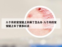 八个月的宝宝腿上长癣了怎么办 八个月的宝宝腿上长了很多红点