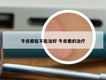 牛皮廨能不能治好 牛皮廨的治疗