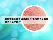 银屑病关节炎疼痛怎么治疗 银屑病关节炎疼痛怎么治疗最好