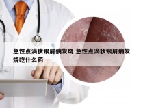 急性点滴状银屑病发烧 急性点滴状银屑病发烧吃什么药