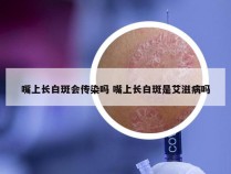 嘴上长白斑会传染吗 嘴上长白斑是艾滋病吗