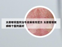 太原哪家医院治牛皮癣有效密方 太原看银屑病哪个医院最好