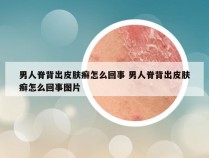 男人脊背出皮肤癣怎么回事 男人脊背出皮肤癣怎么回事图片