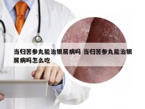 当归苦参丸能治银屑病吗 当归苦参丸能治银屑病吗怎么吃