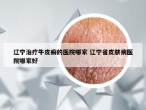 辽宁治疗牛皮癣的医院哪家 辽宁省皮肤病医院哪家好