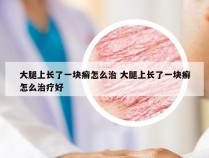 大腿上长了一块癣怎么治 大腿上长了一块癣怎么治疗好