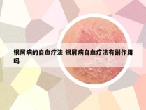 银屑病的自血疗法 银屑病自血疗法有副作用吗