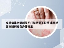 皮肤病生物制剂能不打就尽量不打吗 皮肤病生物制剂打在身体哪里