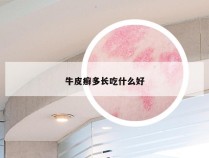 牛皮癣多长吃什么好