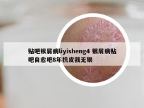 贴吧银屑病liyisheng4 银屑病贴吧自愈吧8年抗皮我无银