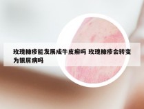 玫瑰糠疹能发展成牛皮癣吗 玫瑰糠疹会转变为银屑病吗