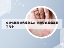 点滴性银屑病头痒怎么办 点滴型银屑病又起了几个