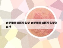 合肥银屑病医院名望 合肥银屑病医院名望怎么样